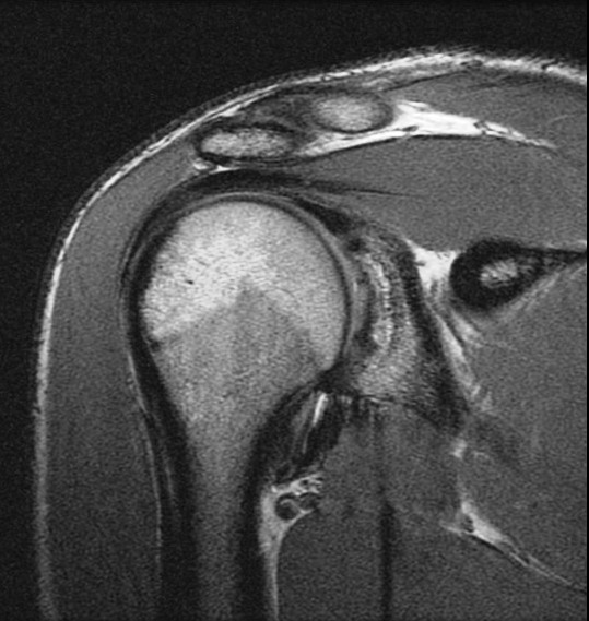 Figure 5 for case Osteochondritis dessicans of the glenoid
